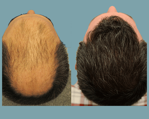 Advanced hair transplantation treatment in vijayawada and hyderabad