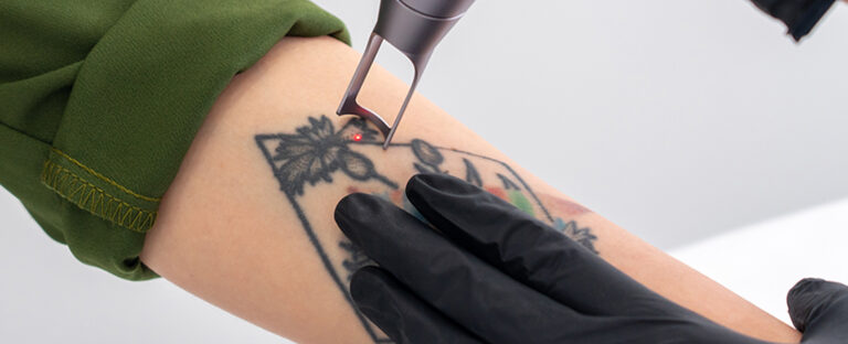 laser tattoo removal clinic