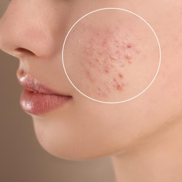 acne treatment clinic in vijayawada, acne treatment clinic in Hyderabad