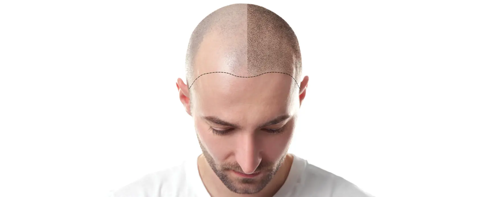 hair transplantation treatment