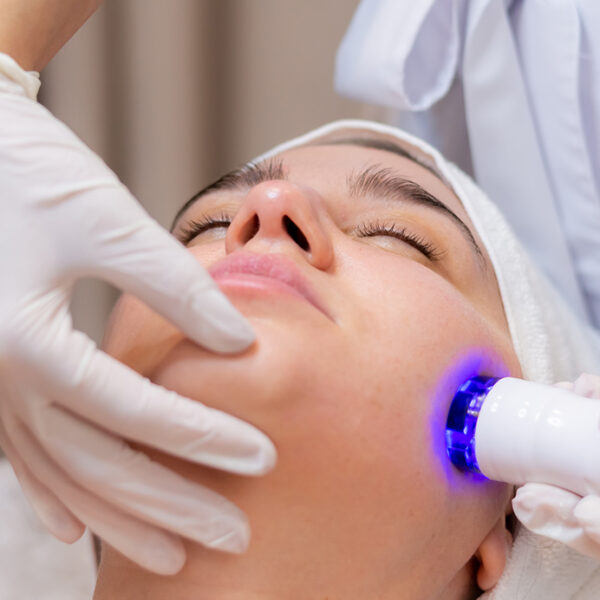 photodynamic therapy for acne
