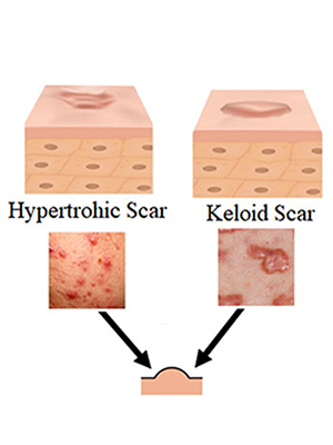 acne scar type_2