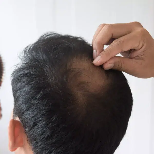 Diffuse Hair Loss