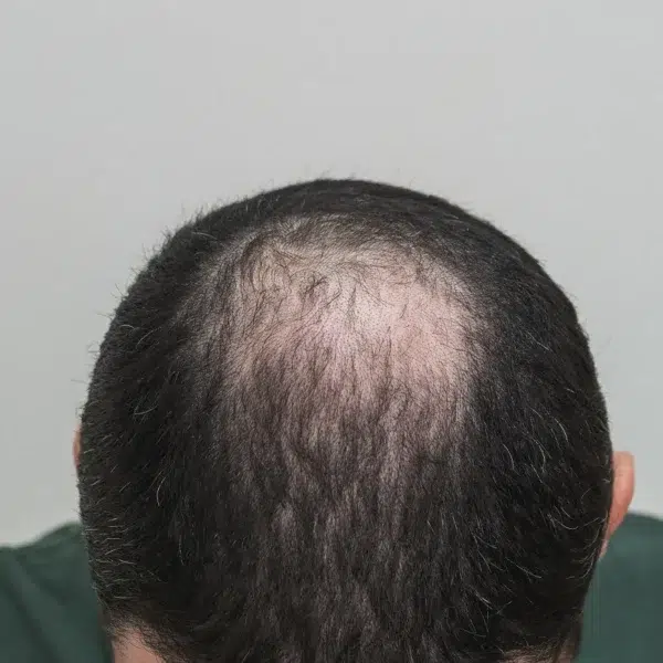 Androgenic Alopecia
