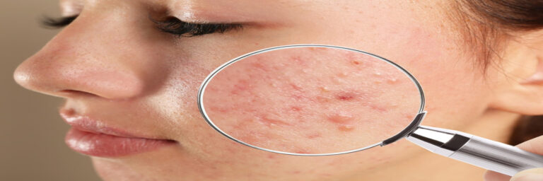 best acne scars treatment