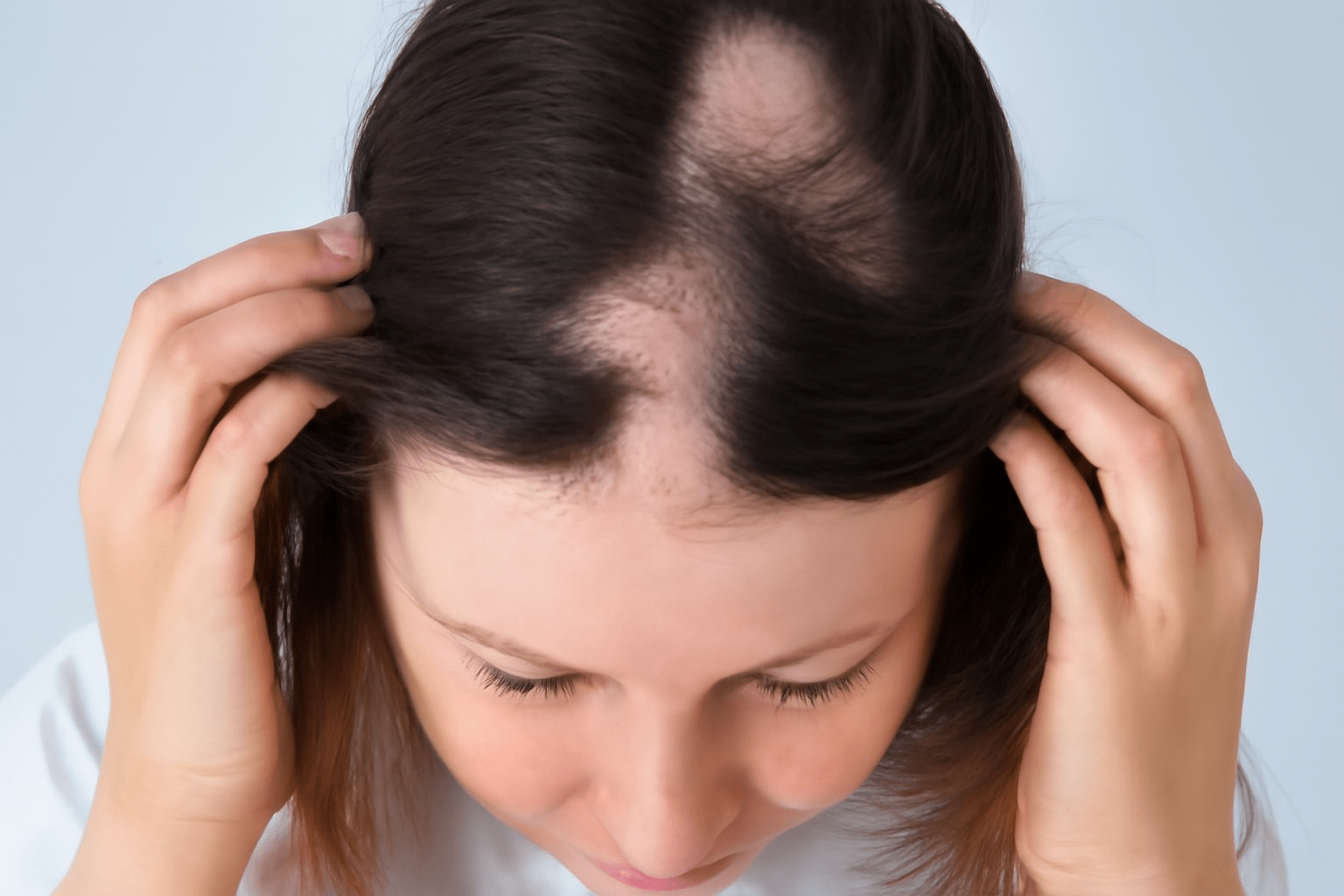 Struggling With Hair Loss? Try the Best Alopecia Areata Treatment in Vijayawada