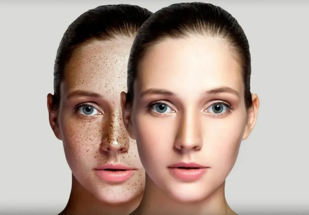 Clear Pigmentation, Dark spots