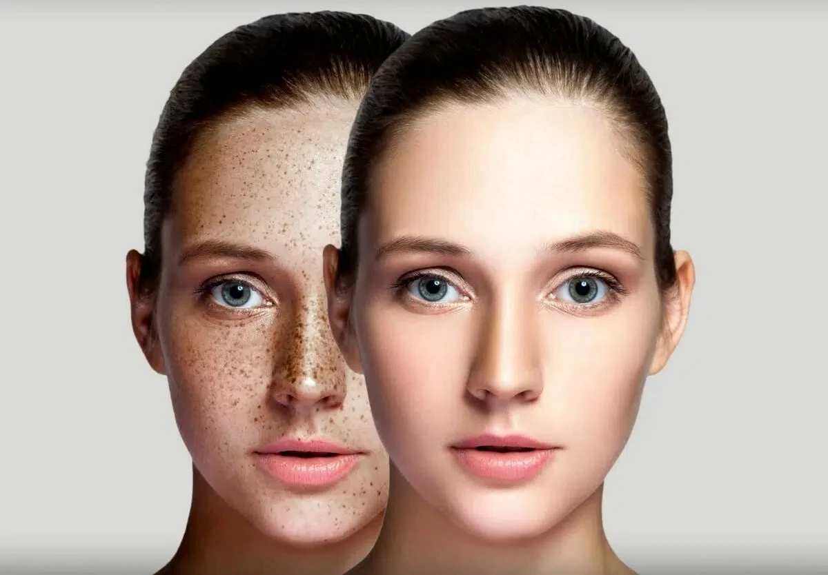 Clear Pigmentation, Dark spots