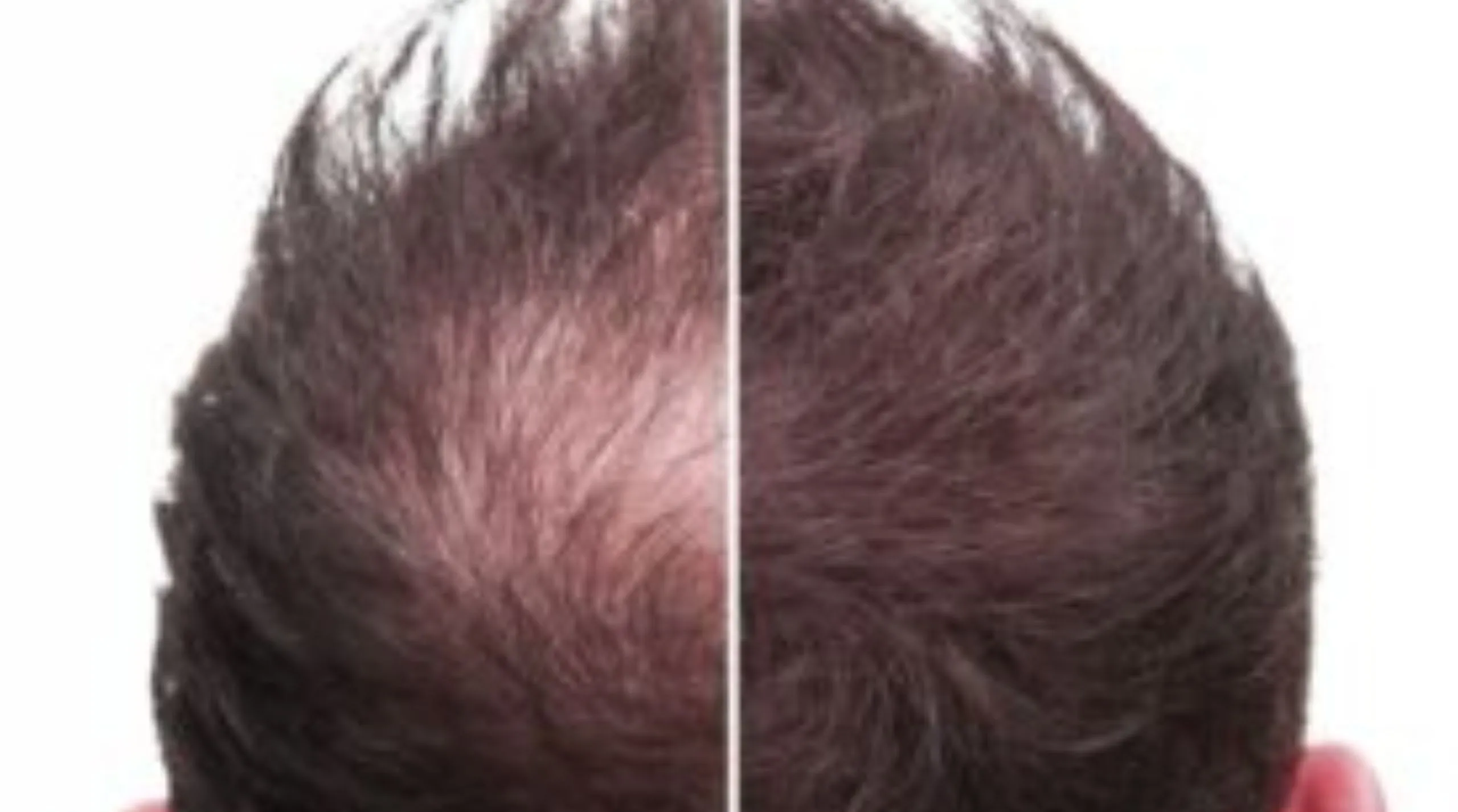 Advanced Hairfall