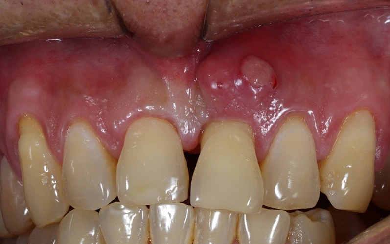 Dental abscess treatment