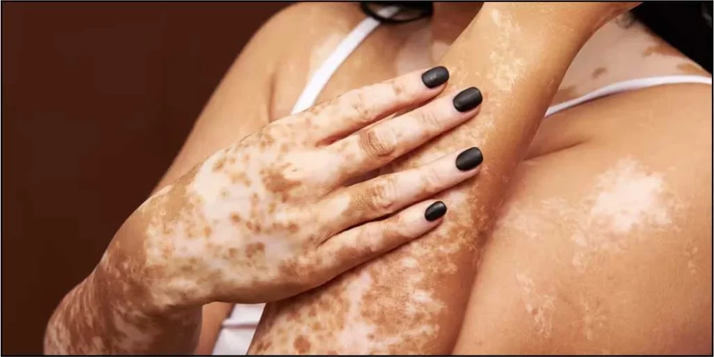 Acrofacial Vitiligo — Vitiligo
