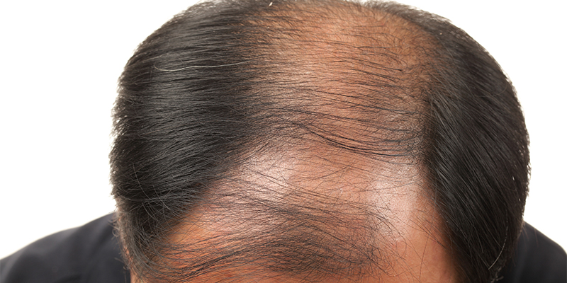 Advanced androgenic hair loss pattern