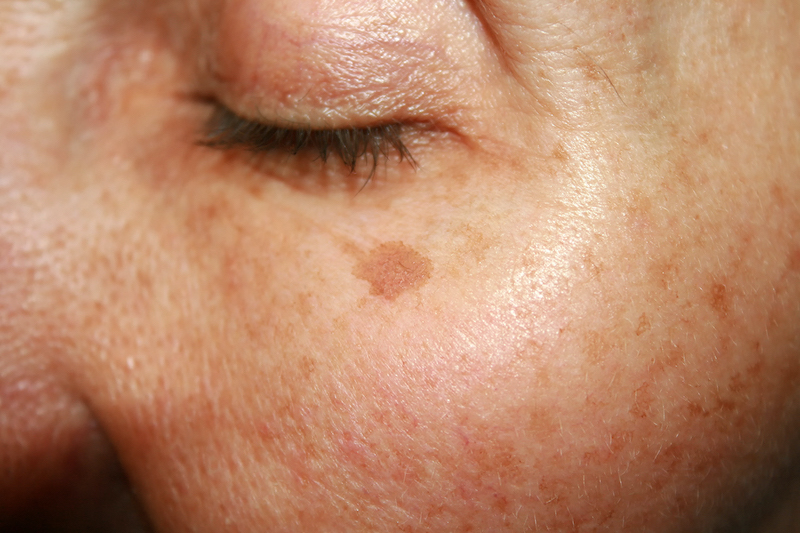 Gravity and facial tissue descent