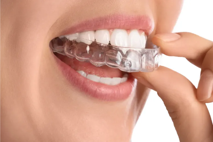 Aligner retainer fitting