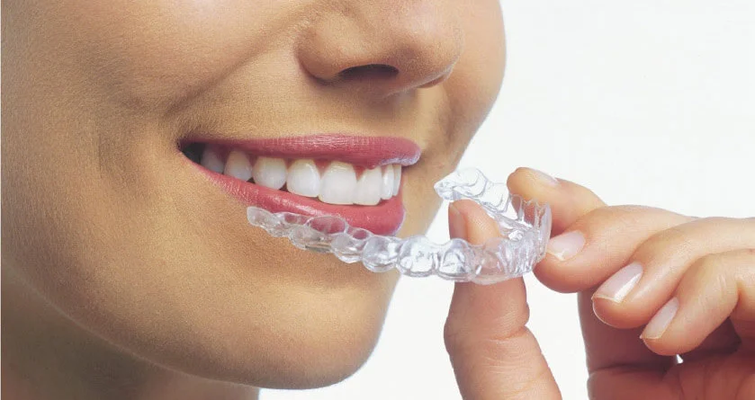 Aligner retainers orthodontic