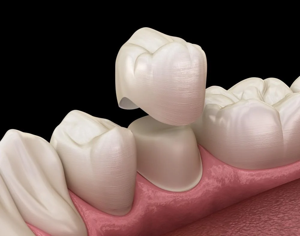 All-ceramic crown natural tooth