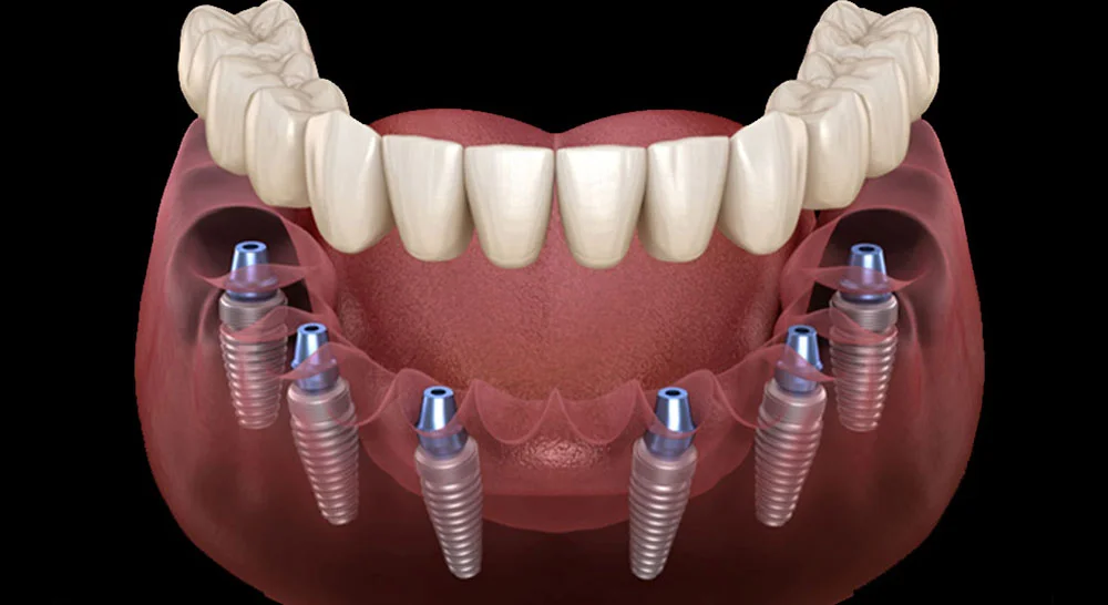 All-on-6 full arch implants