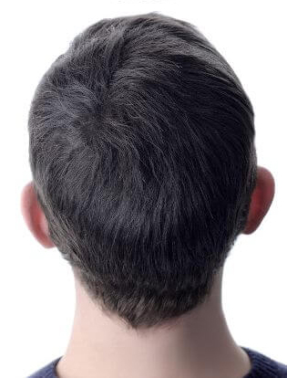 After alopecia areata treatment