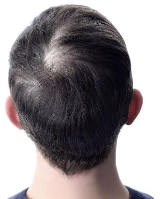 Before alopecia areata