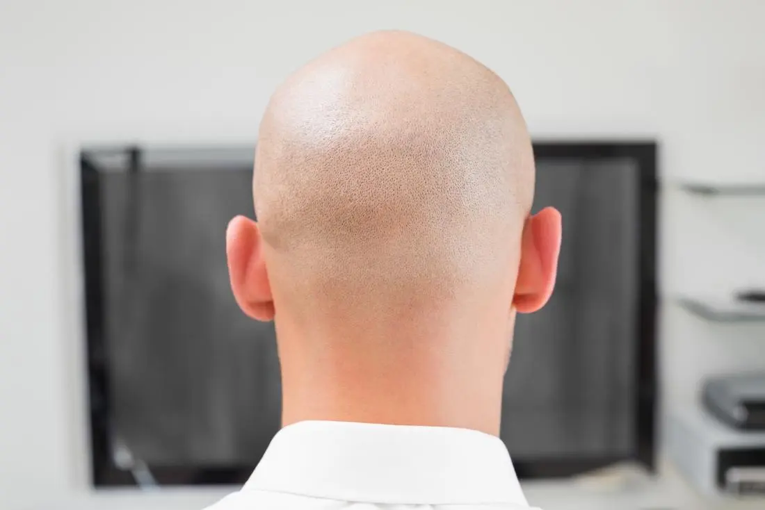 Alopecia totalis complete hair loss scalp