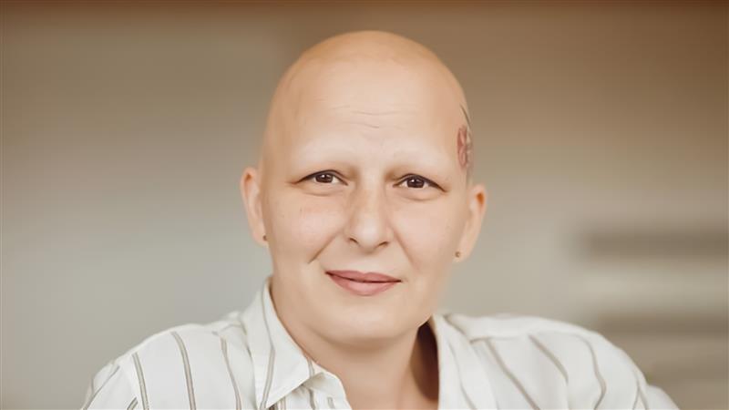 Alopecia universalis hair treatment