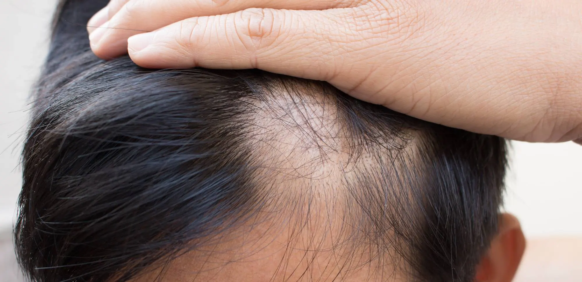 Androgenic Alopecia treatment at Aliva Aesthetics, Vijayawada