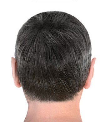 After androgenic alopecia treatment