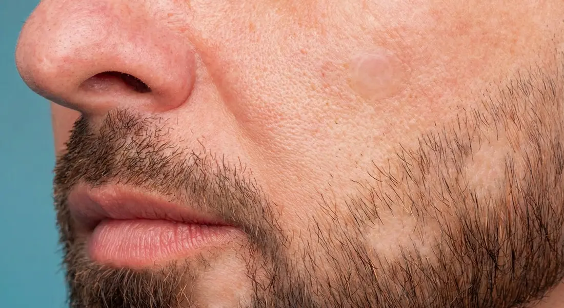Beard alopecia areata patches
