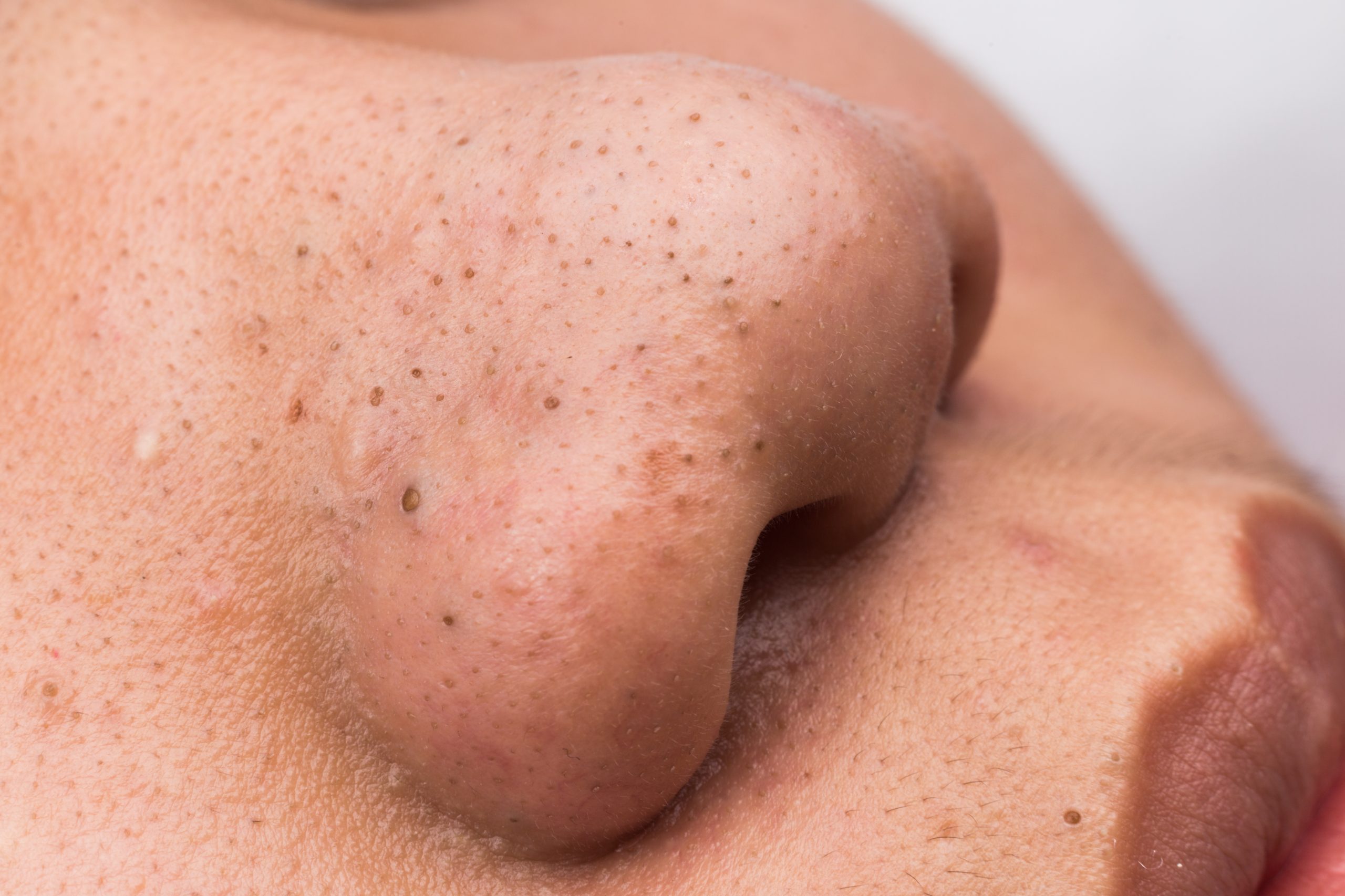 Close-up of skin showing pores