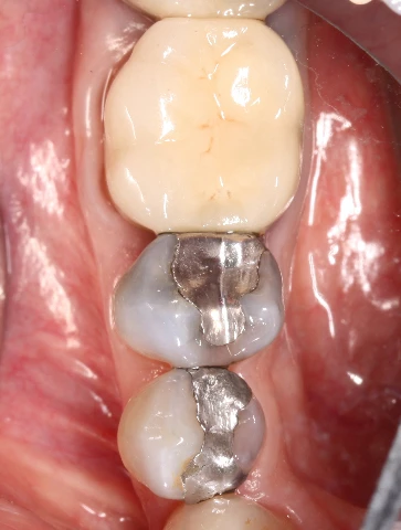 Build-up filling tooth restoration