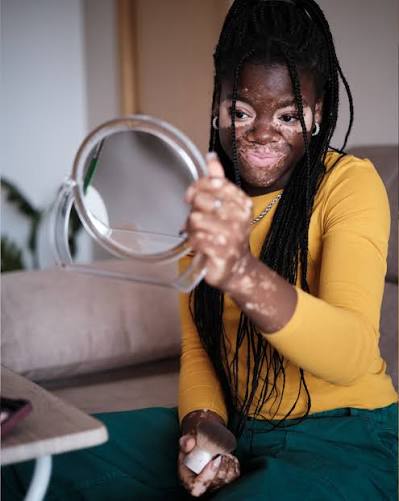 Camouflage & Cosmetic Support — Vitiligo at Aliva Aesthetics