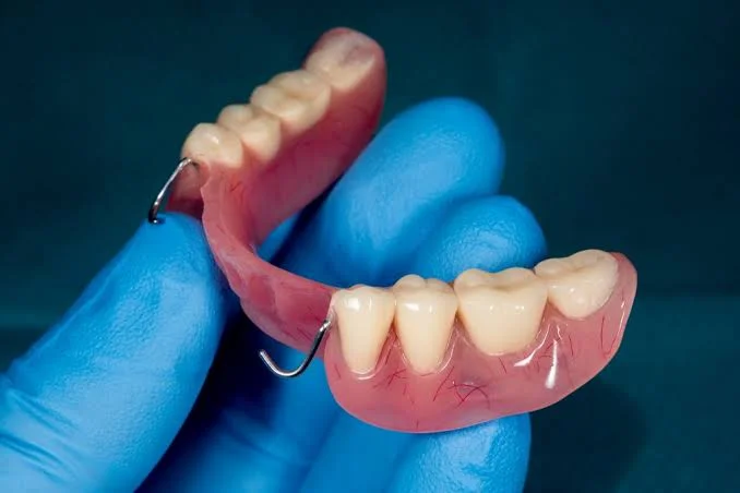 Cast partial dentures metal framework