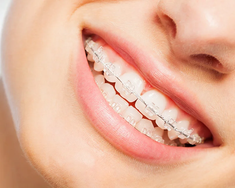 Ceramic braces aesthetic dental