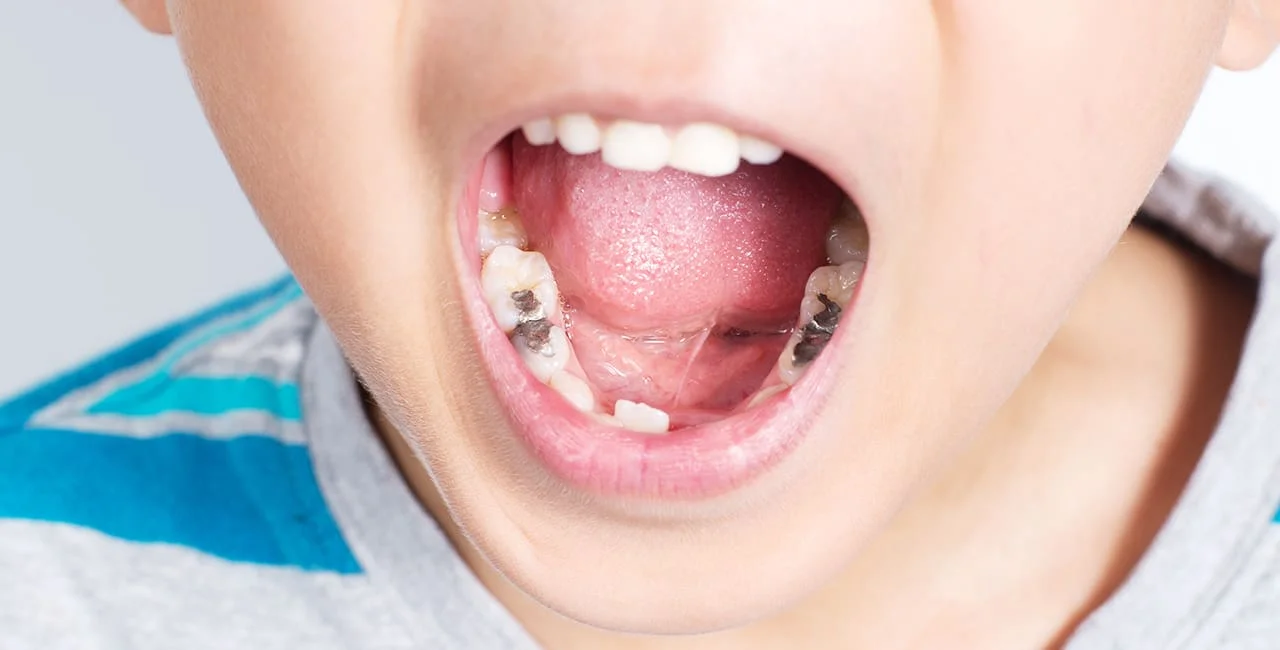 Children's dental fillings painless