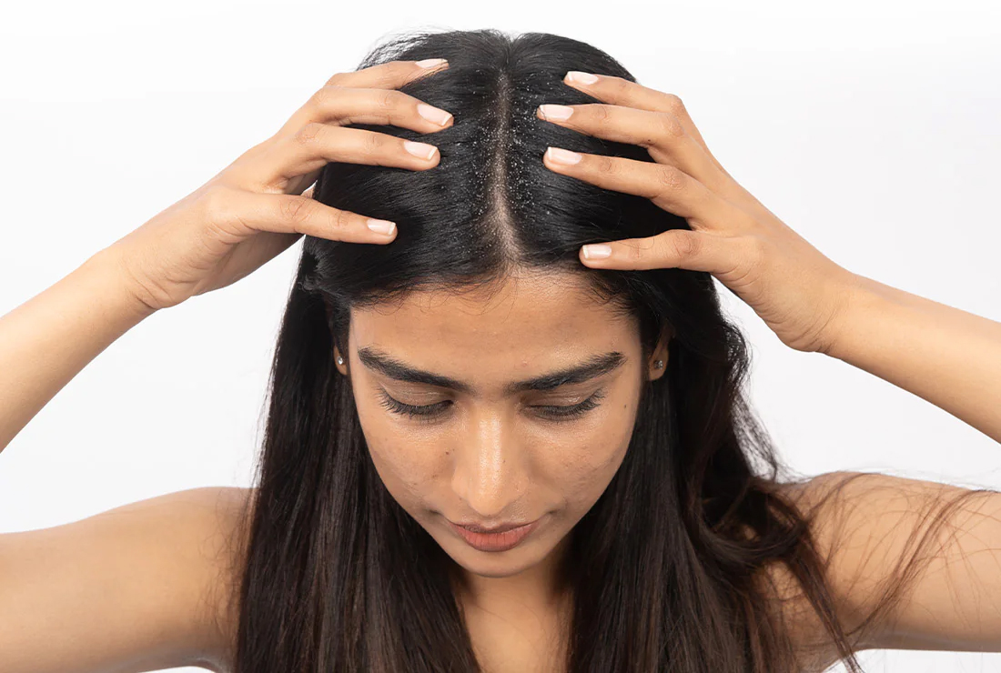 Classic dandruff flaky scalp condition