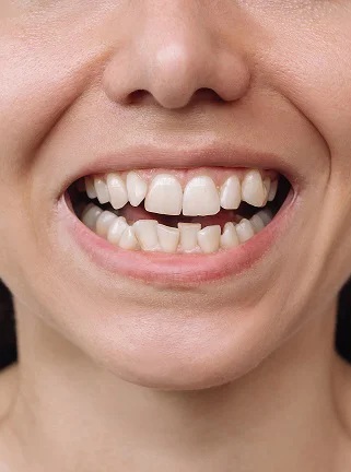 Before denture treatment