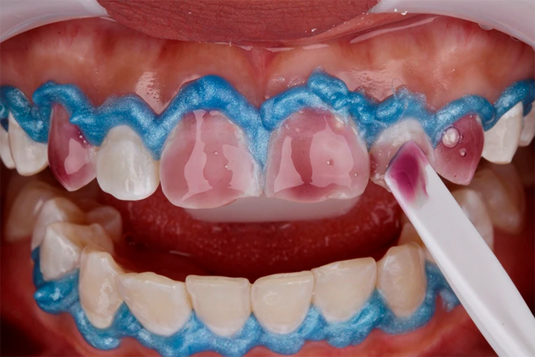 Combined whitening protocol dental