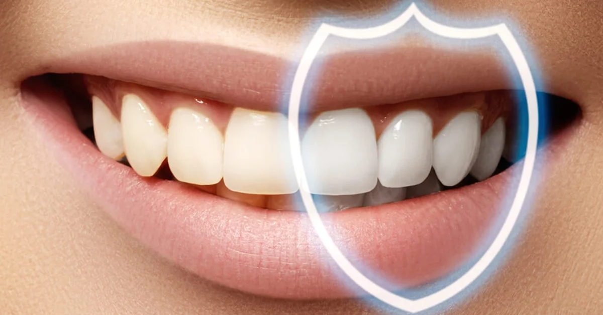 Composite bonding teeth restoration