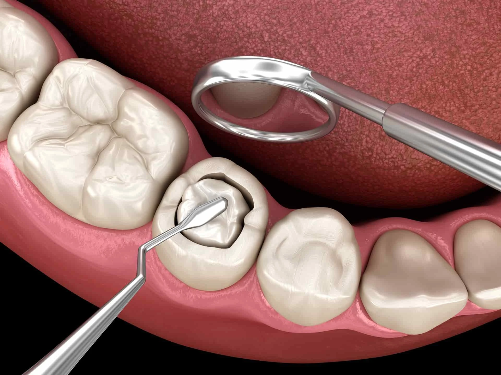 Composite filling tooth decay treatment