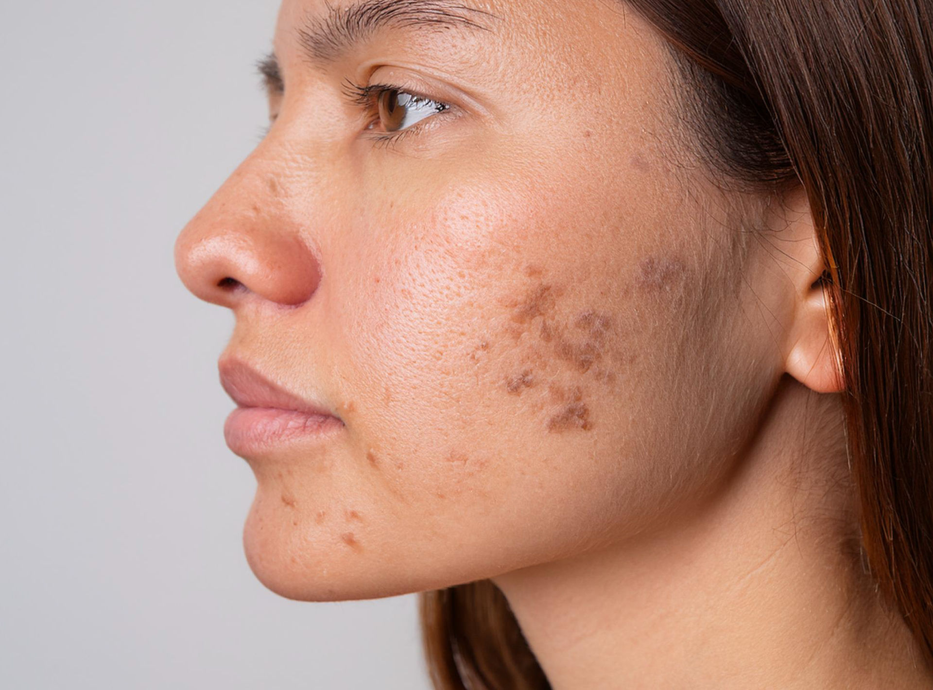 Comprehensive pigmentation protocol treatment