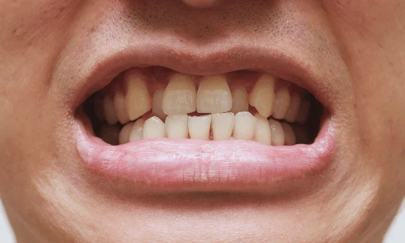 Crossbite braces treatment