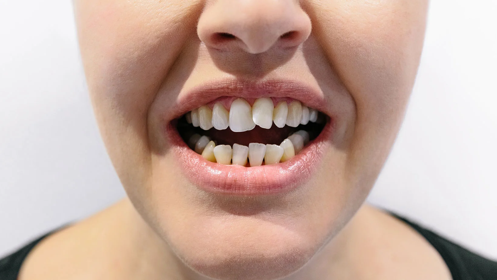 Crowded teeth braces treatment