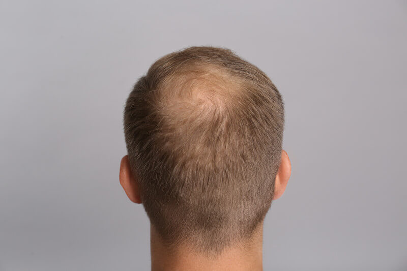 Crown balding male pattern baldness