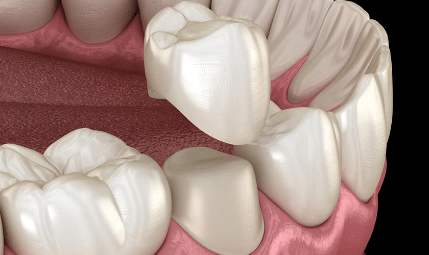 Crown care advice dental