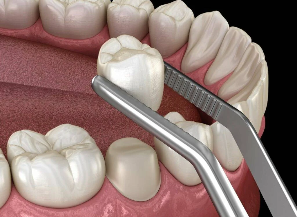 Crown fitting placement dental