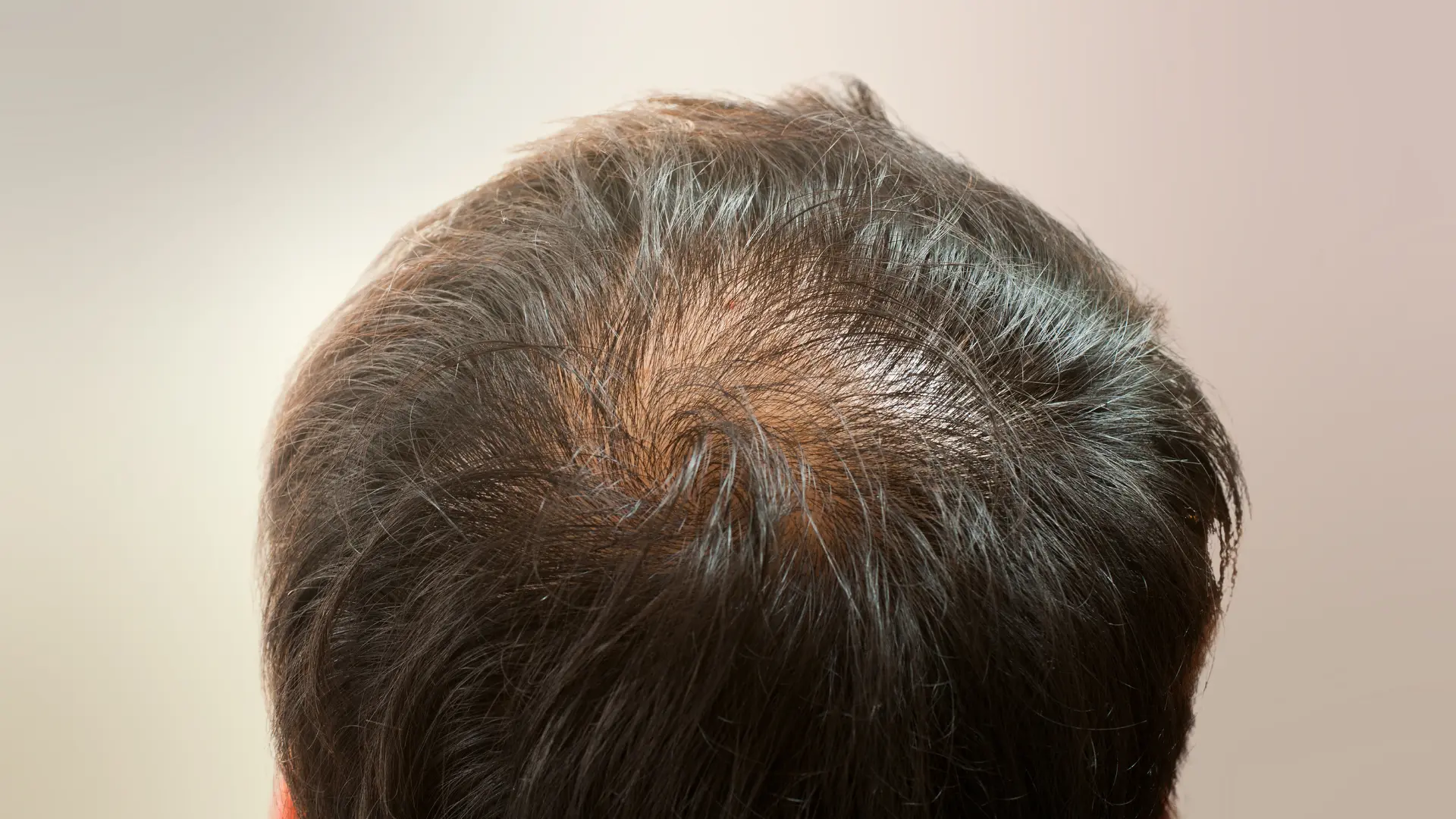 Crown thinning GFC scalp therapy