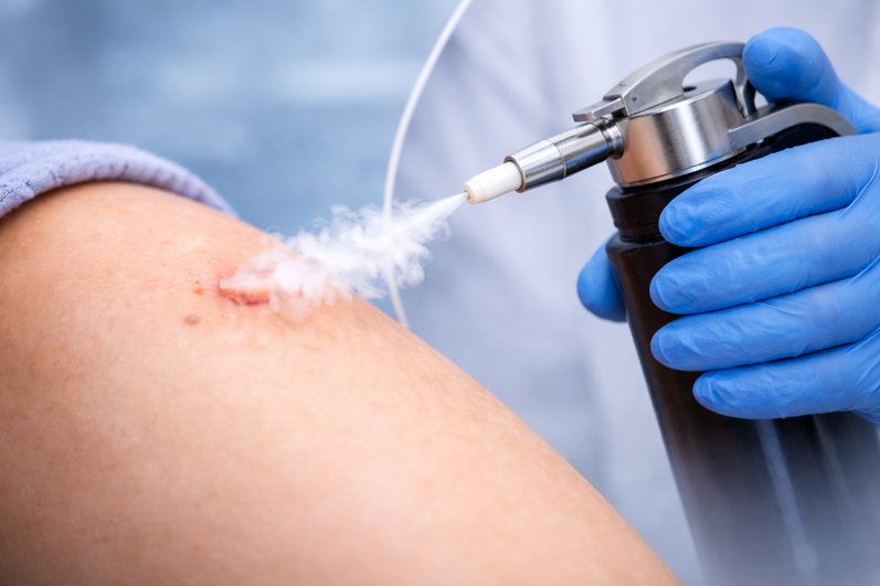 Cryotherapy — Skin Tags & Warts at Aliva Aesthetics