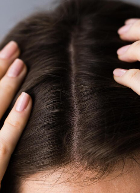 After dandruff treatment treatment