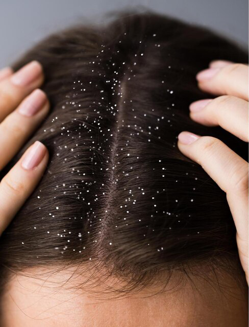 Before dandruff treatment