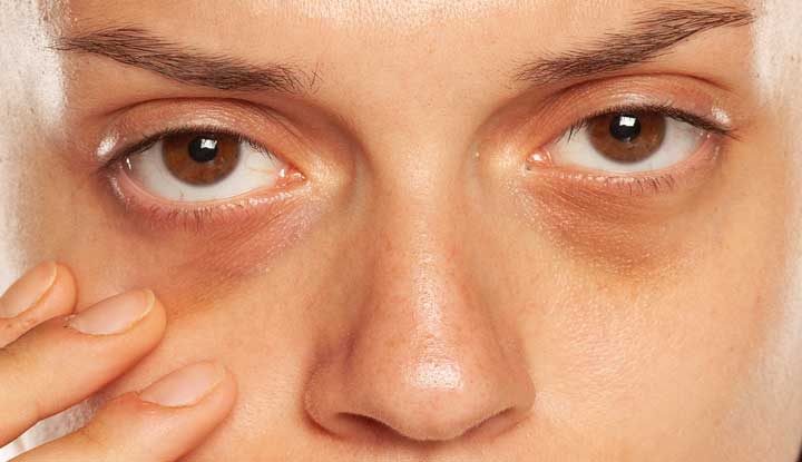 Thin skin genetic dark circles